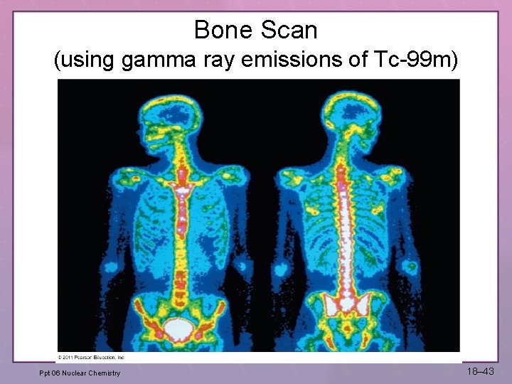 Bone Scan (using gamma ray emissions of Tc-99 m) Ppt 06 Nuclear Chemistry 18–