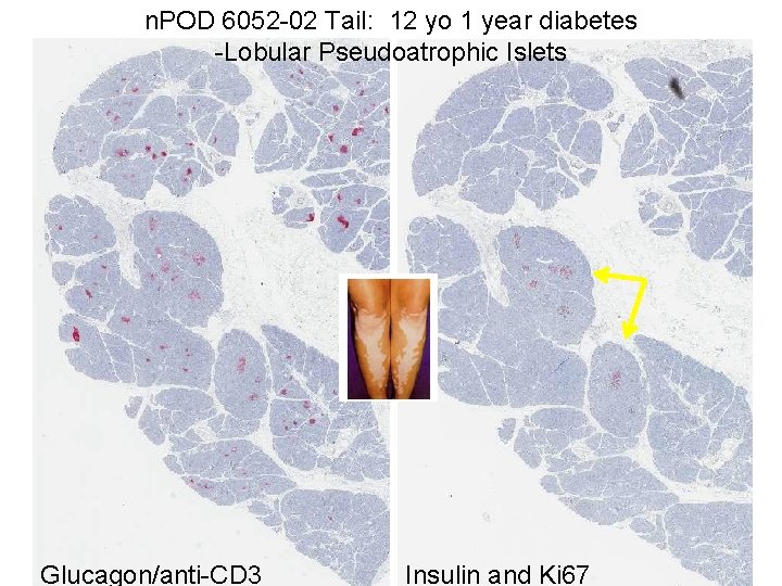 n. POD 6052 -02 Tail: 12 yo 1 year diabetes -Lobular Pseudoatrophic Islets Glucagon/anti-CD