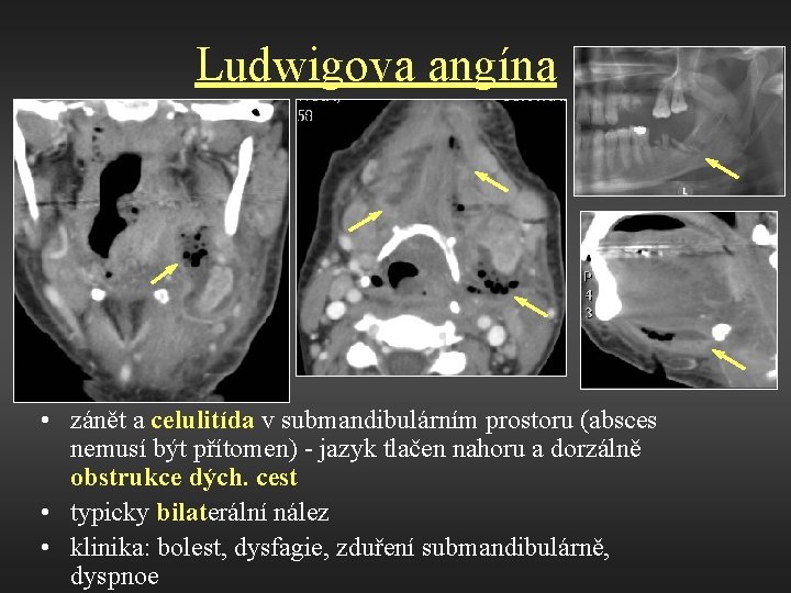 Ludwigova angína • zánět a celulitída v submandibulárním prostoru (absces nemusí být přítomen) -