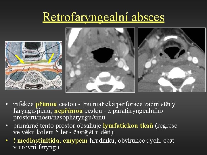 Retrofaryngealní absces • infekce přímou cestou - traumatická perforace zadní stěny faryngu/jícnu; nepřímou cestou