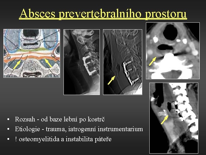 Absces prevertebralního prostoru • Rozsah - od baze lební po kostrč • Etiologie -