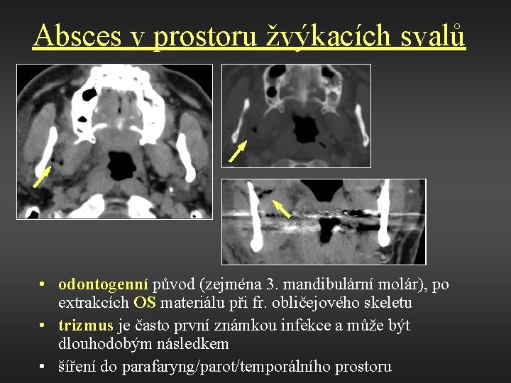 Absces v prostoru žvýkacích svalů • odontogenní původ (zejména 3. mandibulární molár), po extrakcích