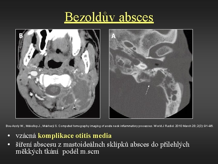 Bezoldův absces Bou-Assly W. , Mckellop J. , Mukherji S. Computed tomography imaging of