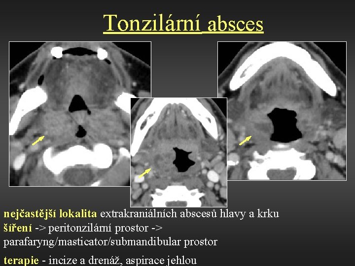 Tonzilární absces nejčastější lokalita extrakraniálních abscesů hlavy a krku šíření -> peritonzilární prostor ->