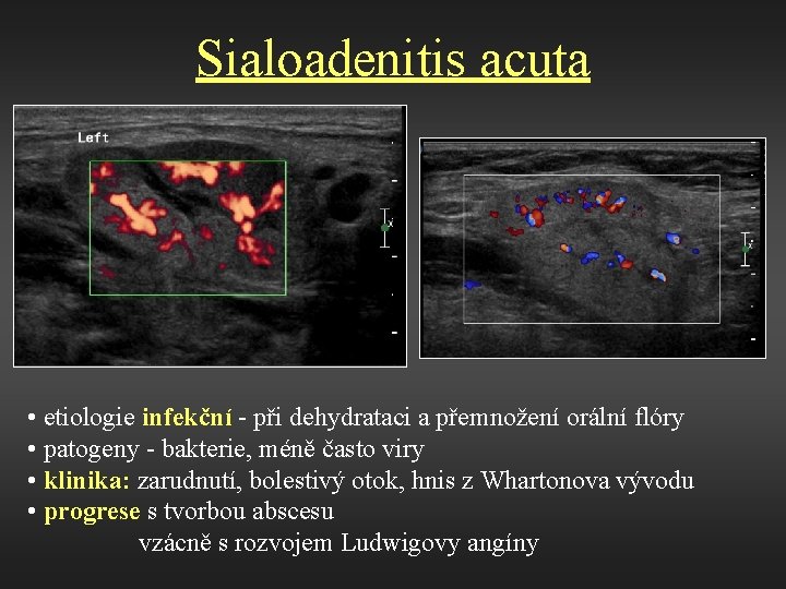 Sialoadenitis acuta • etiologie infekční - při dehydrataci a přemnožení orální flóry • patogeny