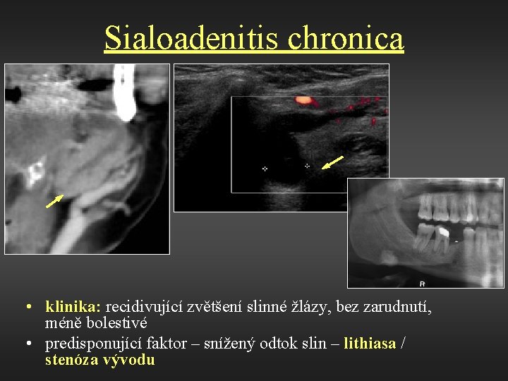 Sialoadenitis chronica • klinika: recidivující zvětšení slinné žlázy, bez zarudnutí, méně bolestivé • predisponující