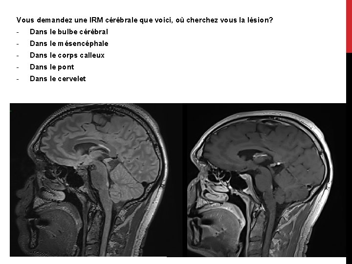 Vous demandez une IRM cérébrale que voici, où cherchez vous la lésion? - Dans