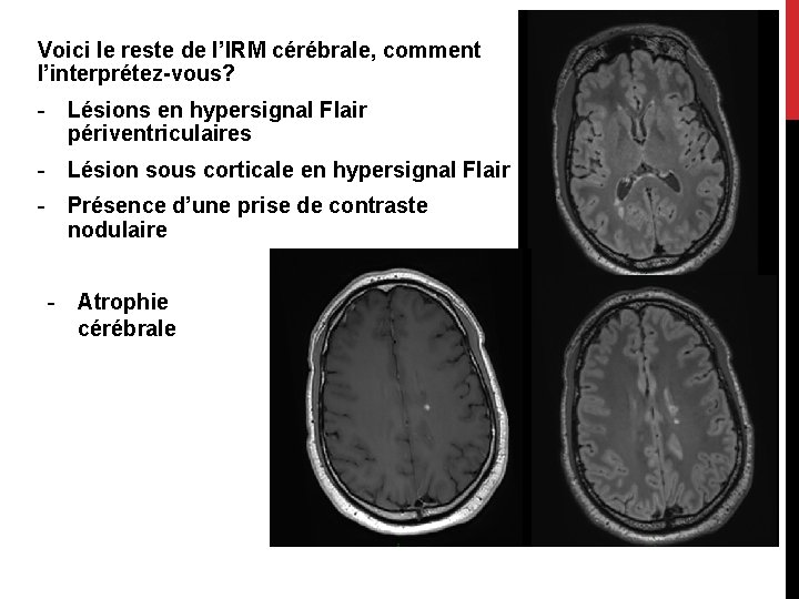 Voici le reste de l’IRM cérébrale, comment l’interprétez-vous? - Lésions en hypersignal Flair périventriculaires