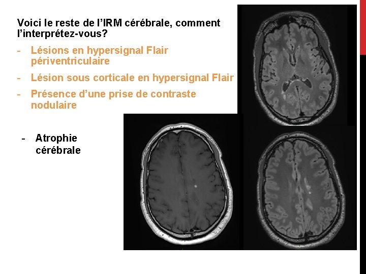 Voici le reste de l’IRM cérébrale, comment l’interprétez-vous? - Lésions en hypersignal Flair périventriculaire