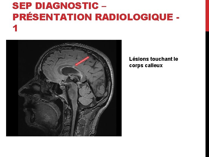 SEP DIAGNOSTIC – PRÉSENTATION RADIOLOGIQUE 1 Lésions touchant le corps calleux 