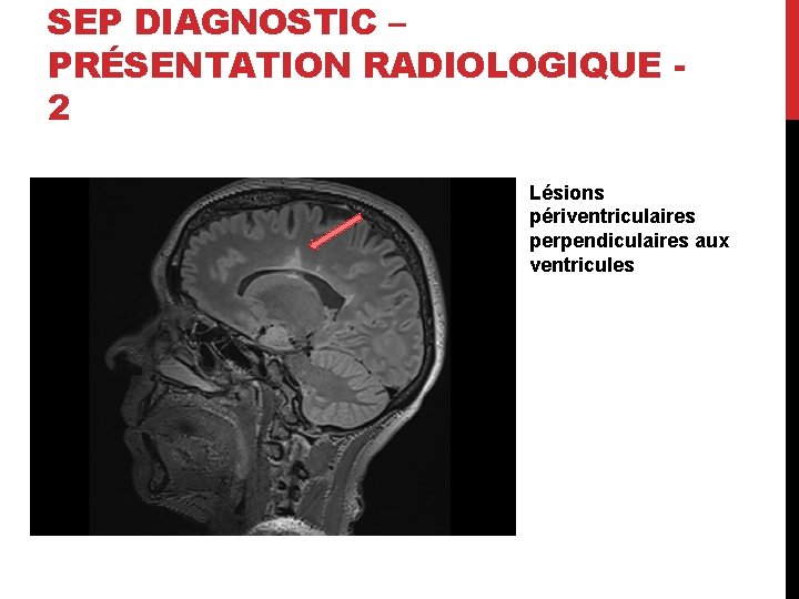 SEP DIAGNOSTIC – PRÉSENTATION RADIOLOGIQUE 2 Lésions périventriculaires perpendiculaires aux ventricules 