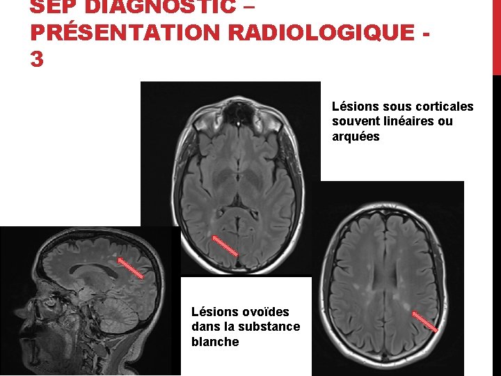 SEP DIAGNOSTIC – PRÉSENTATION RADIOLOGIQUE 3 Lésions sous corticales souvent linéaires ou arquées Lésions