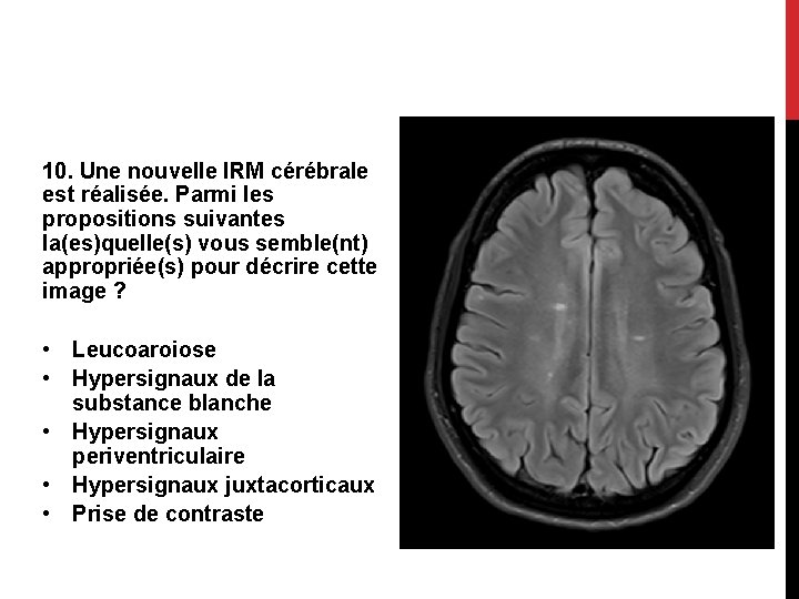 10. Une nouvelle IRM cérébrale est réalisée. Parmi les propositions suivantes la(es)quelle(s) vous semble(nt)