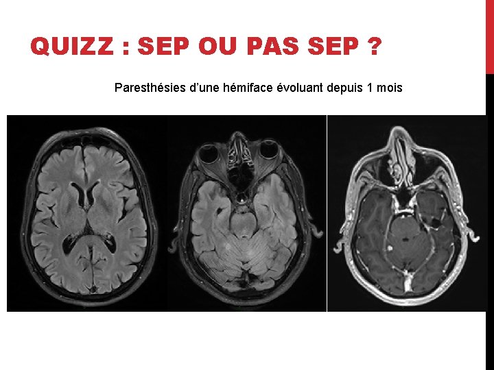 QUIZZ : SEP OU PAS SEP ? Paresthésies d’une hémiface évoluant depuis 1 mois