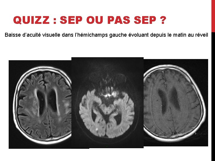 QUIZZ : SEP OU PAS SEP ? Baisse d’acuité visuelle dans l’hémichamps gauche évoluant