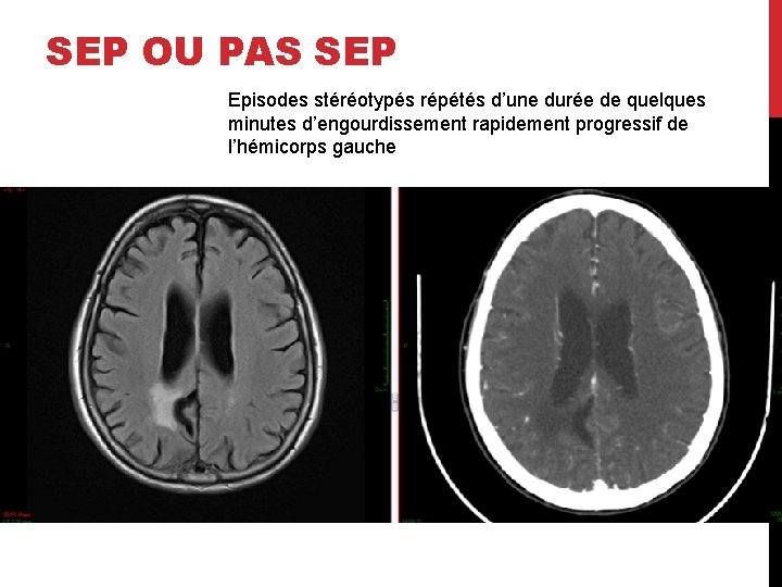 SEP OU PAS SEP Episodes stéréotypés répétés d’une durée de quelques minutes d’engourdissement rapidement