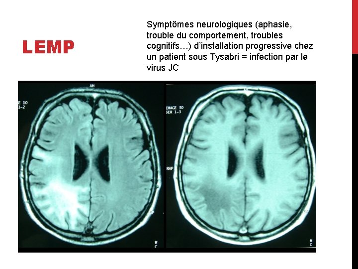 LEMP Symptômes neurologiques (aphasie, trouble du comportement, troubles cognitifs…) d’installation progressive chez un patient
