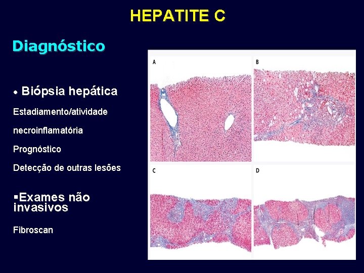 HEPATITE C Diagnóstico • Biópsia hepática Estadiamento/atividade necroinflamatória Prognóstico Detecção de outras lesões §Exames