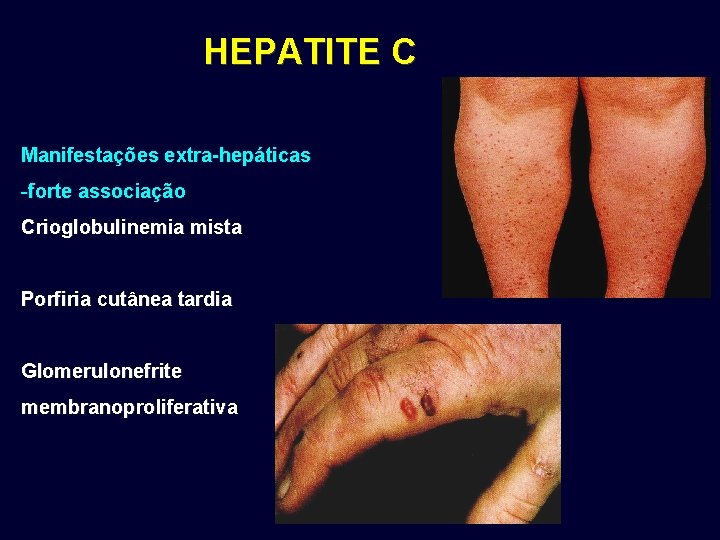 HEPATITE C Manifestações extra-hepáticas -forte associação Crioglobulinemia mista Porfiria cutânea tardia Glomerulonefrite membranoproliferativa HEPATITE C Manifestações extra-hepáticas -forte associação Crioglobulinemia mista Porfiria cutânea tardia Glomerulonefrite membranoproliferativa