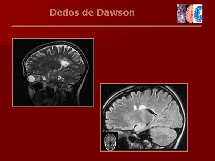 Dedos de Dawson 