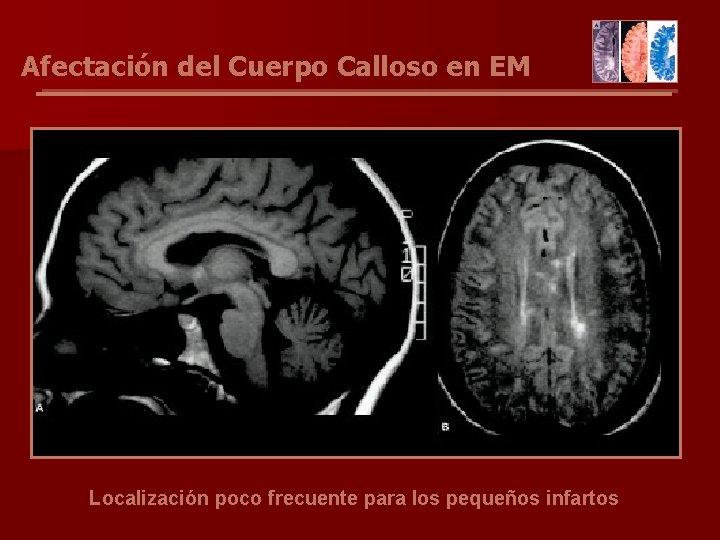 Afectación del Cuerpo Calloso en EM Localización poco frecuente para los pequeños infartos 