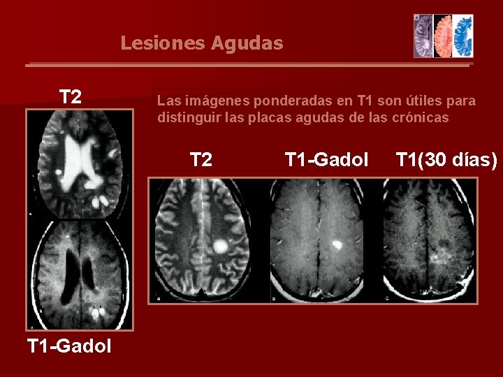 Lesiones Agudas T 2 Las imágenes ponderadas en T 1 son útiles para distinguir