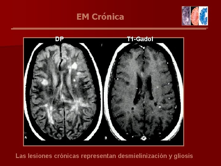 EM Crónica DP T 1 -Gadol Las lesiones crónicas representan desmielinización y gliosis 