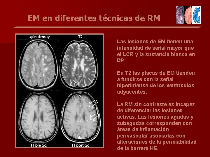 EM en diferentes técnicas de RM Las lesiones de EM tienen una intensidad de