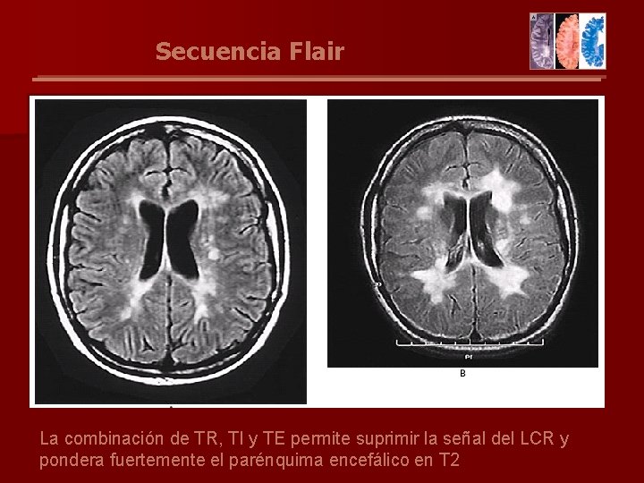 Secuencia Flair La combinación de TR, TI y TE permite suprimir la señal del