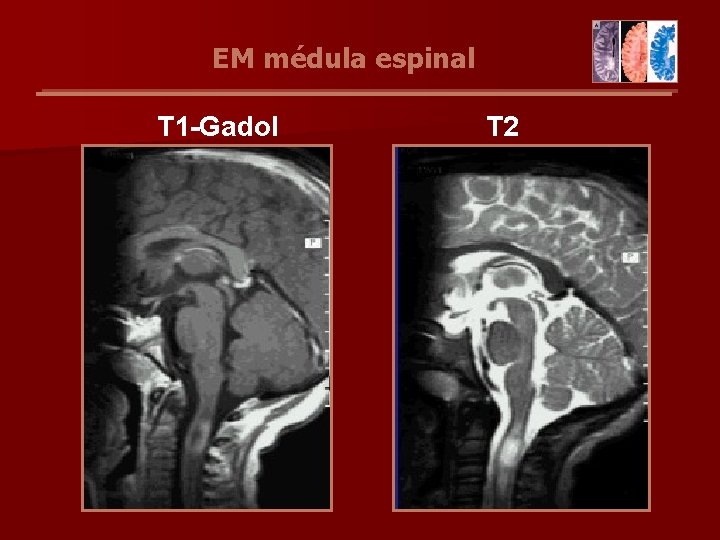 EM médula espinal T 1 -Gadol T 2 