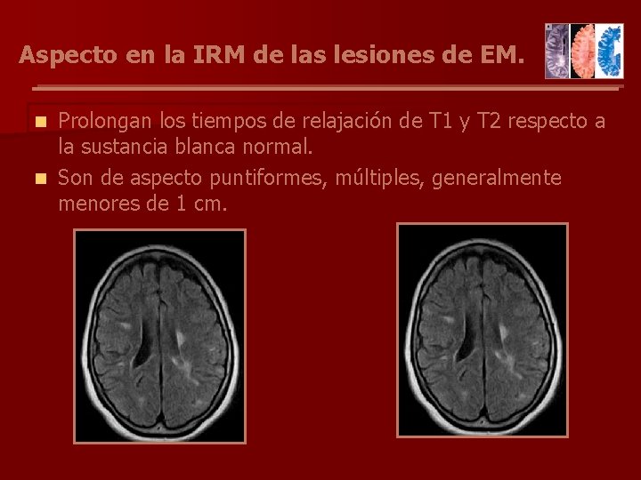 Aspecto en la IRM de las lesiones de EM. Prolongan los tiempos de relajación