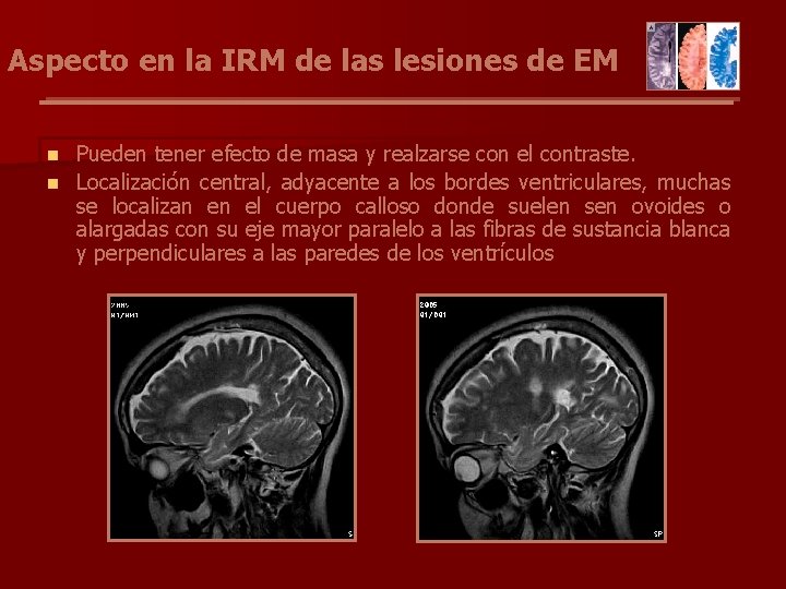 Aspecto en la IRM de las lesiones de EM Pueden tener efecto de masa