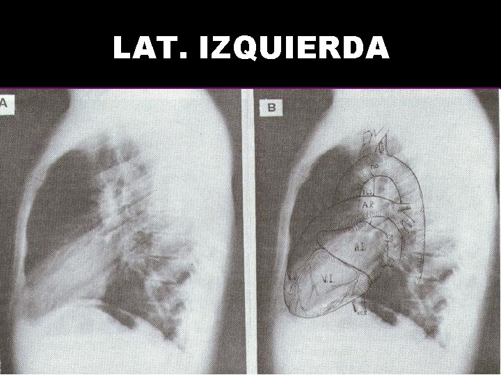 LAT. IZQUIERDA 