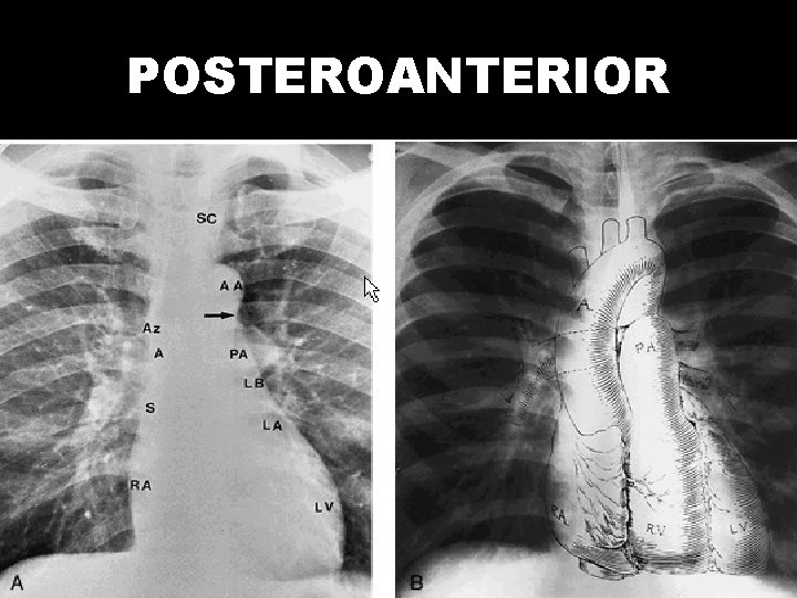 POSTEROANTERIOR 