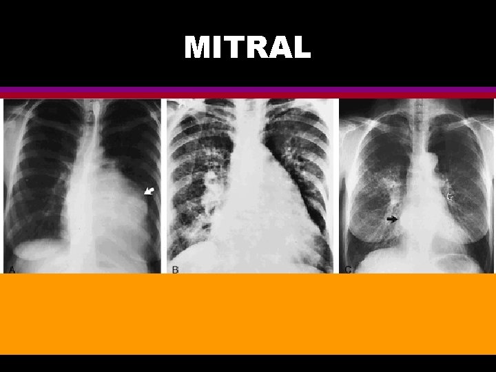 MITRAL 