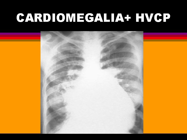 CARDIOMEGALIA+ HVCP 