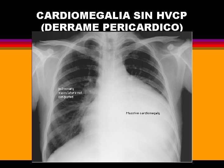 CARDIOMEGALIA SIN HVCP (DERRAME PERICARDICO) 