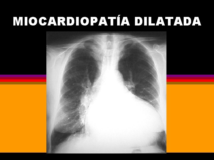 MIOCARDIOPATÍA DILATADA 