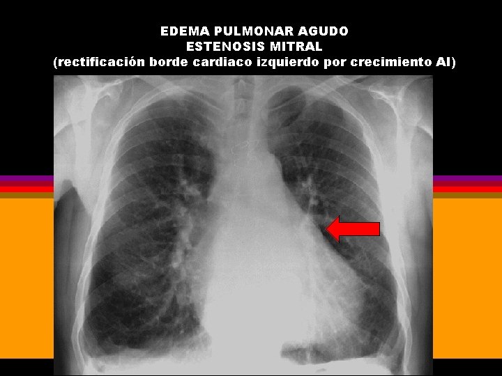 EDEMA PULMONAR AGUDO ESTENOSIS MITRAL (rectificación borde cardiaco izquierdo por crecimiento AI) 