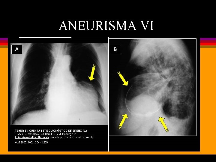 ANEURISMA VI 