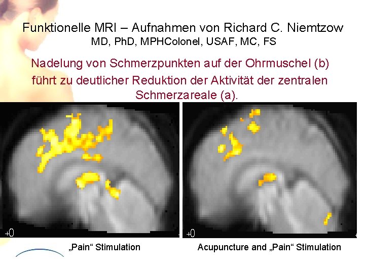 Funktionelle MRI – Aufnahmen von Richard C. Niemtzow MD, Ph. D, MPHColonel, USAF, MC,