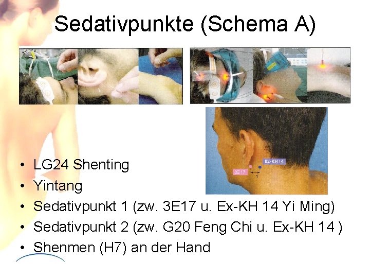 Sedativpunkte (Schema A) • • • LG 24 Shenting Yintang Sedativpunkt 1 (zw. 3 Sedativpunkte (Schema A) • • • LG 24 Shenting Yintang Sedativpunkt 1 (zw. 3