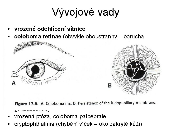 Vývojové vady • vrozené odchlípení sítnice • coloboma retinae (obvykle oboustranný – porucha uzavírání