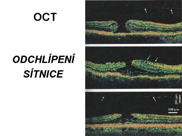 OCT ODCHLÍPENÍ SÍTNICE 