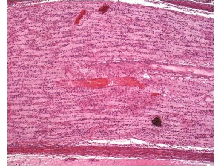 Nervus opticus • • výchlipka diencefala (thalamus opticus) axony odděleny endoneuriem na povrchu jsou