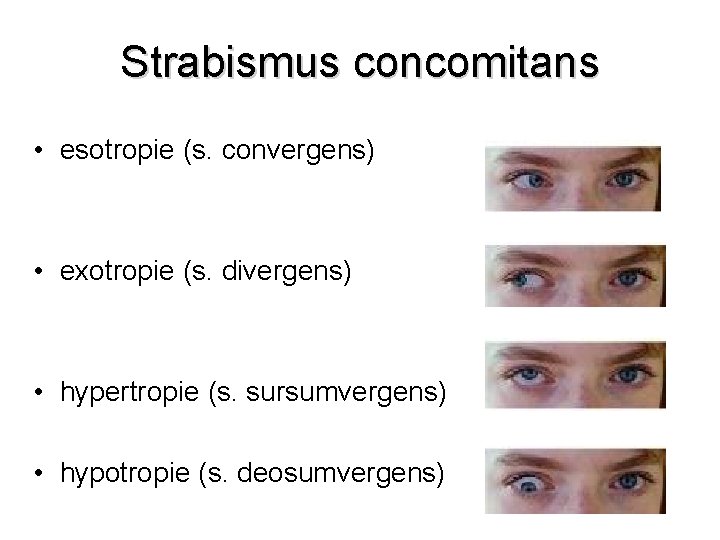 Strabismus concomitans • esotropie (s. convergens) • exotropie (s. divergens) • hypertropie (s. sursumvergens)