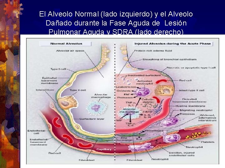 El Alveolo Normal (lado izquierdo) y el Alveolo Dañado durante la Fase Aguda de El Alveolo Normal (lado izquierdo) y el Alveolo Dañado durante la Fase Aguda de