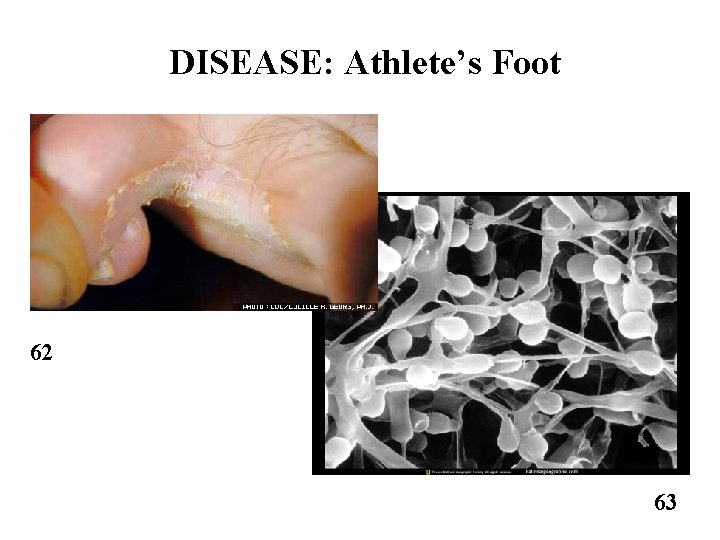 DISEASE: Athlete’s Foot 62 63 