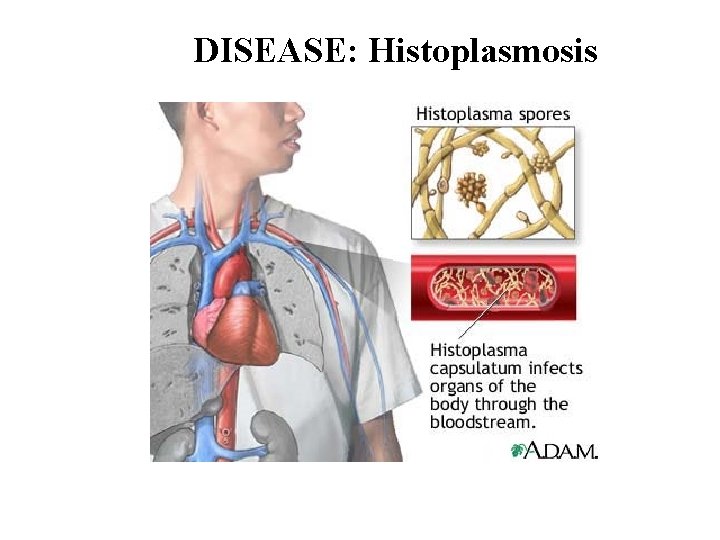 DISEASE: Histoplasmosis 