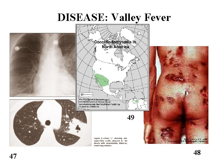 DISEASE: Valley Fever 49 47 48 